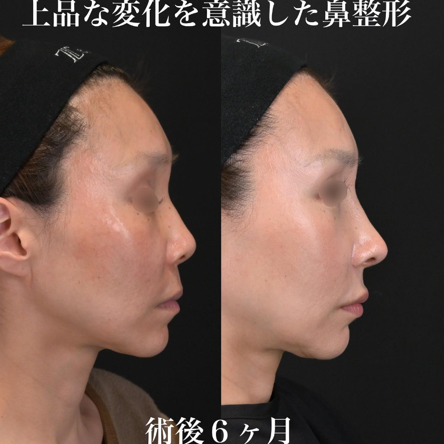 鉄医師による鼻整形の施術前／施術後6ヶ月 术后 