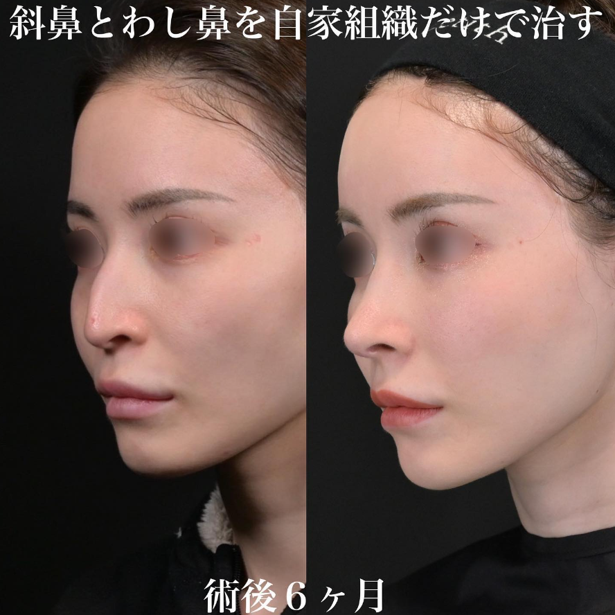 鉄医師による鼻整形の施術前／施術後6ヶ月