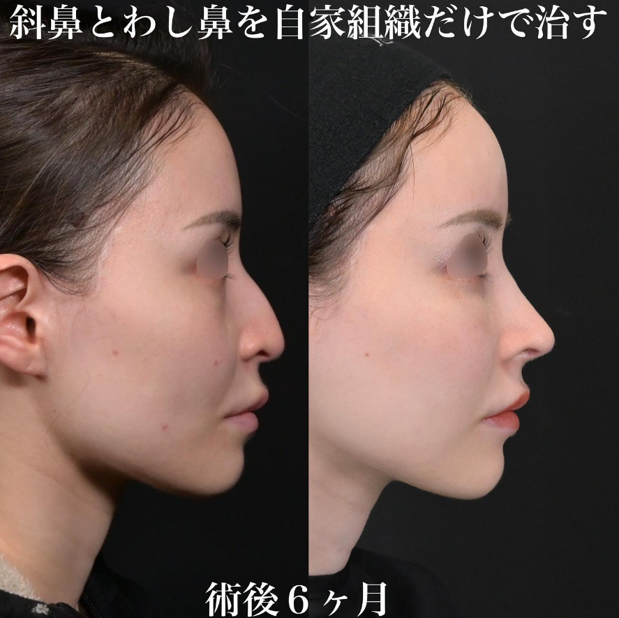 鉄医師による鼻整形の施術前／施術後6ヶ月 Дараа 