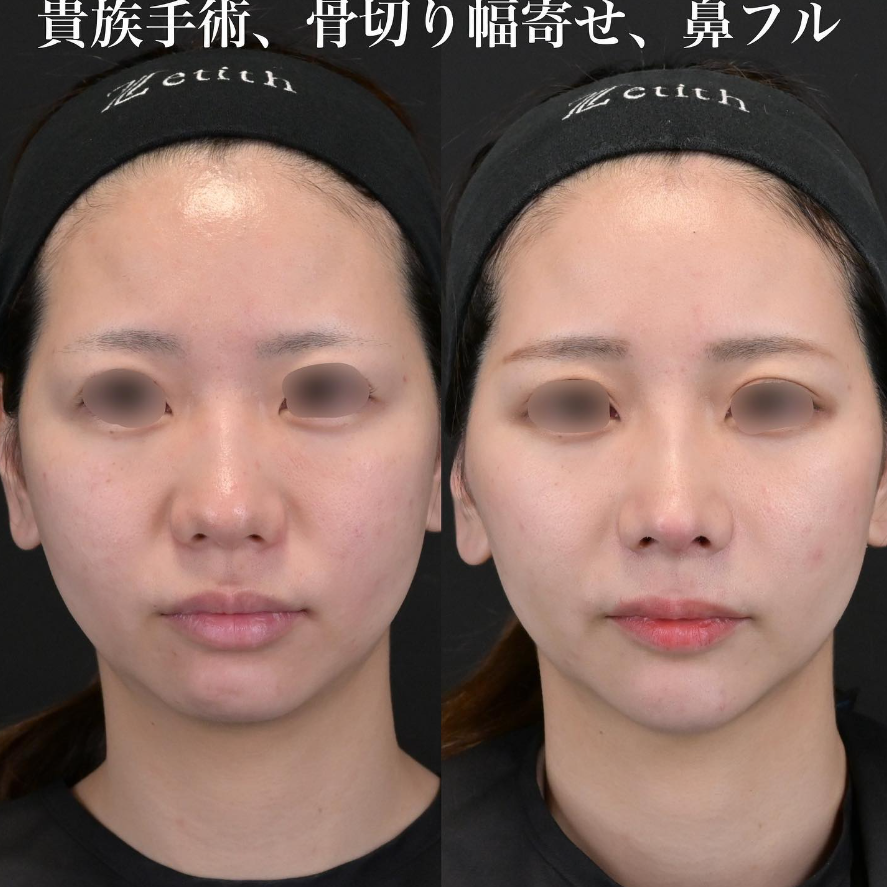 鉄医師による鼻整形の施術前／施術後1ヶ月