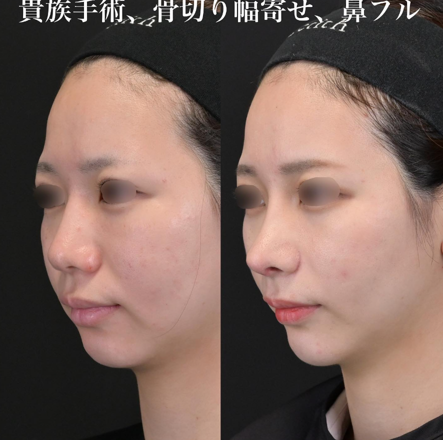 鉄医師による鼻整形の施術前／施術後1ヶ月 施術後 