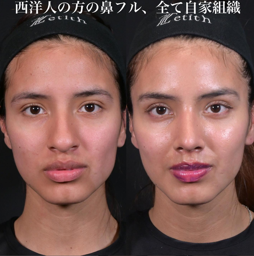 鉄医師による鼻整形の施術前／施術後1ヶ月 Sau 