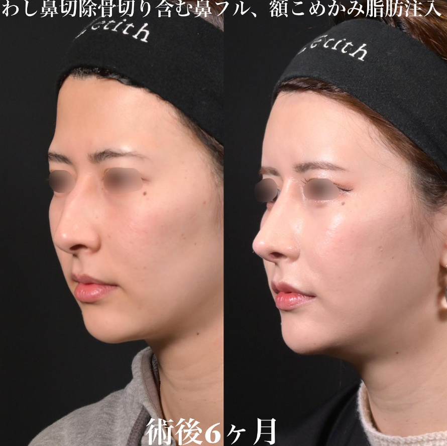 鉄医師による鼻整形の施術前／施術後6ヶ月