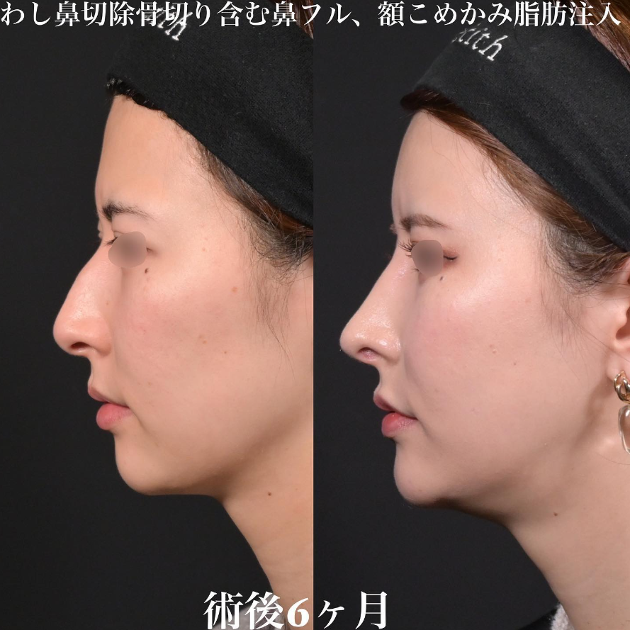 鉄医師による鼻整形の施術前／施術後6ヶ月 施術後 