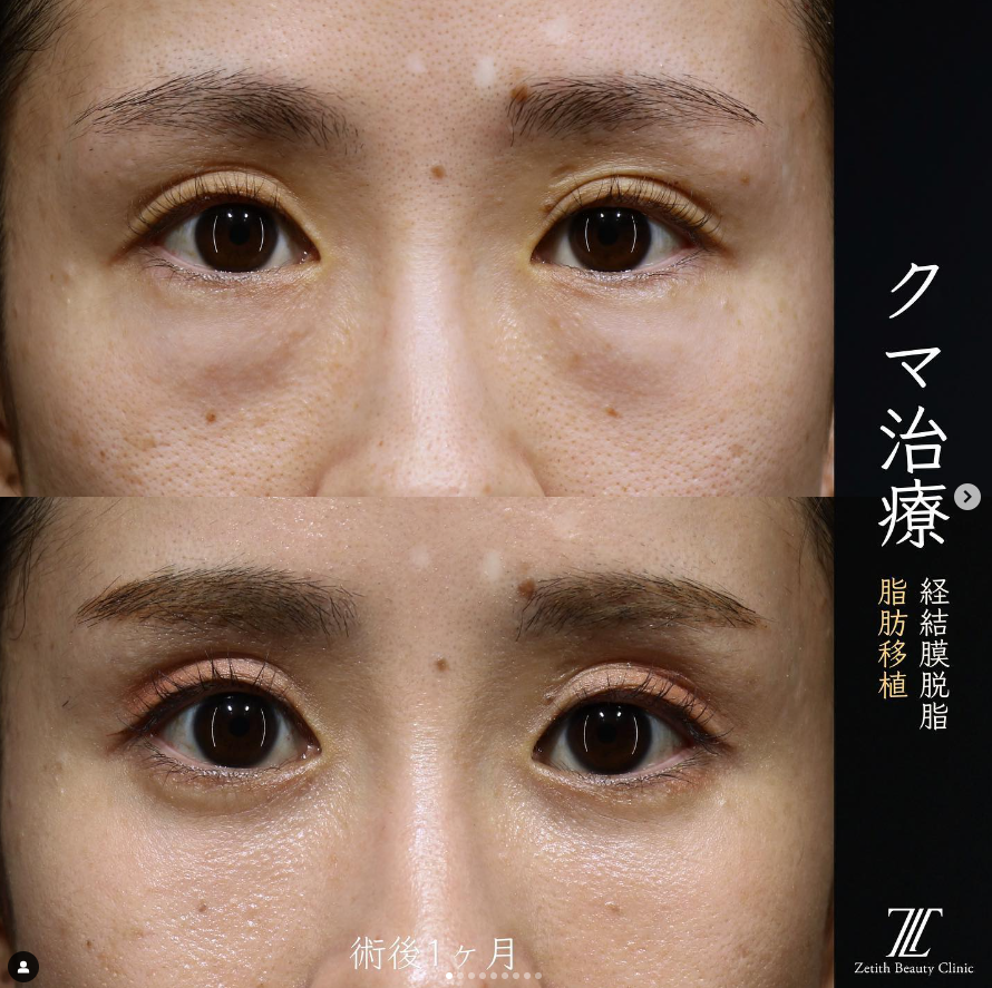 王医師によるクマ治療の施術前／施術後1ヶ月 术后 