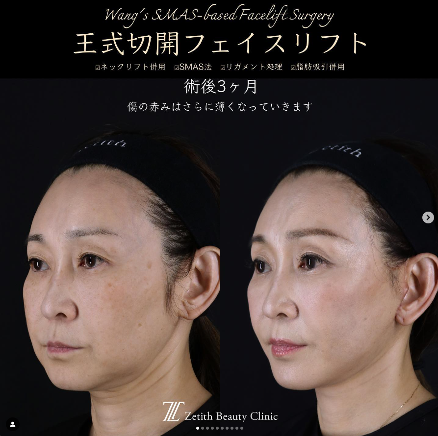王医師による切開リフトの施術前／施術後3ヶ月