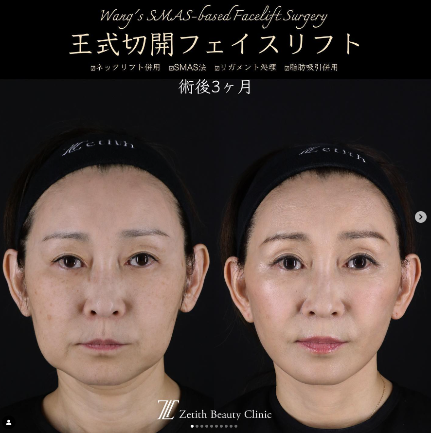 王医師による切開リフトの施術前／施術後3ヶ月 施術後 
