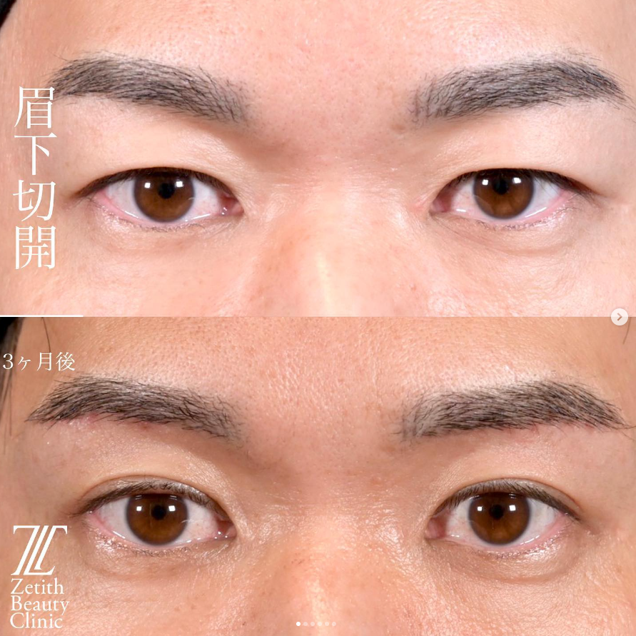 上木原医師による眉下切開の施術前／施術後3ヶ月
