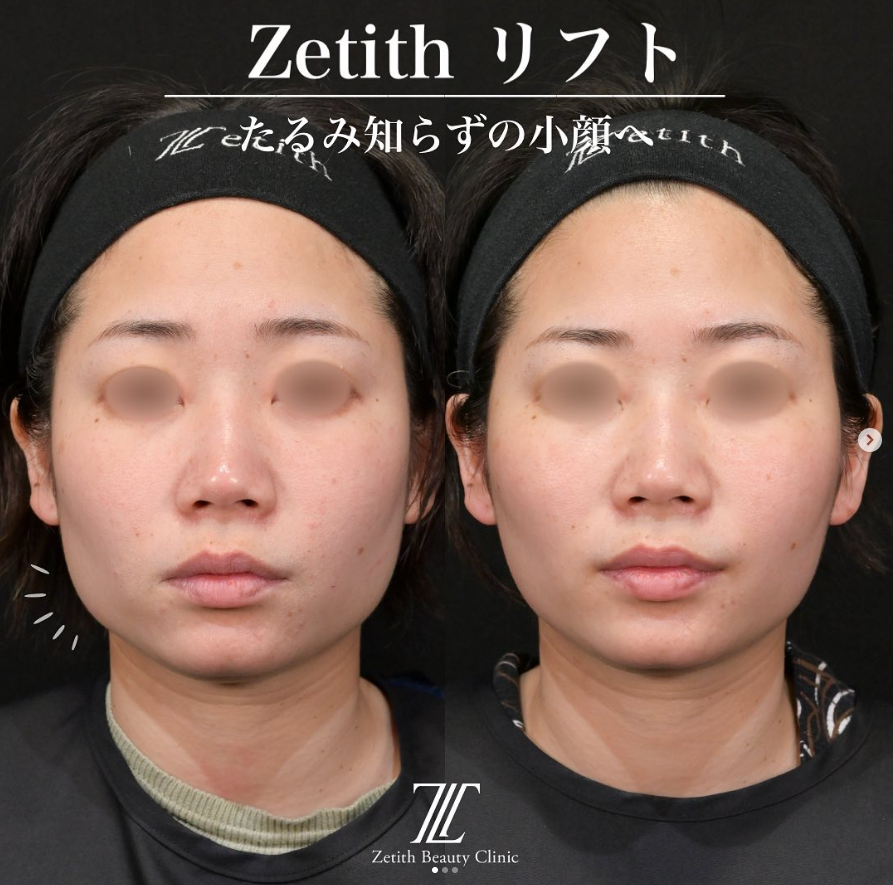 新井医師による糸リフトの施術前／施術後1ヶ月