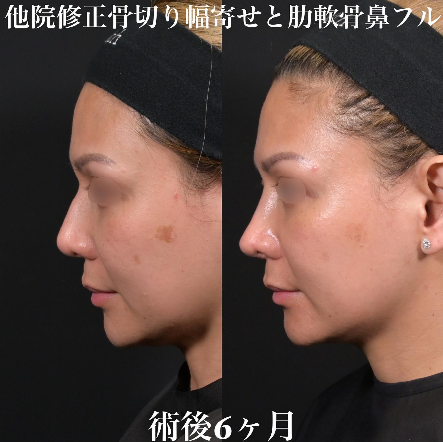 鉄医師による鼻整形の施術前／施術後6ヶ月