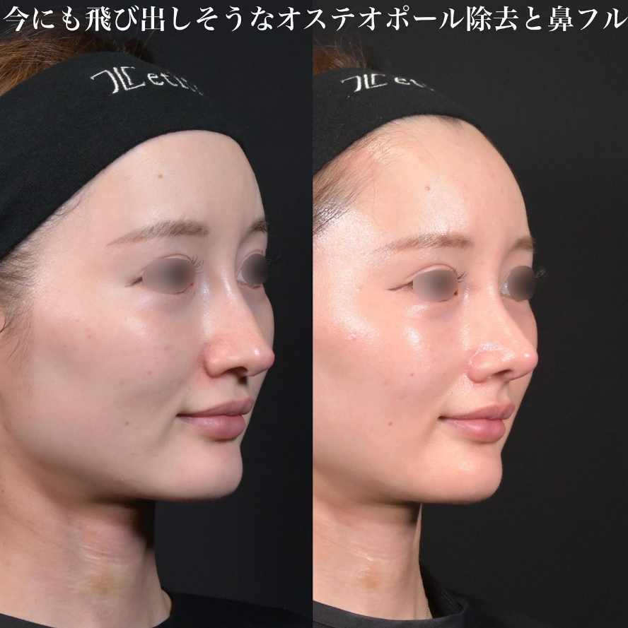 鉄医師による鼻整形の施術前／施術後1ヶ月 术后 