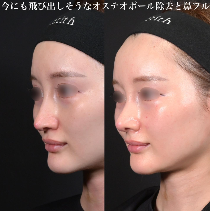 鉄医師による鼻整形の施術前／施術後1ヶ月