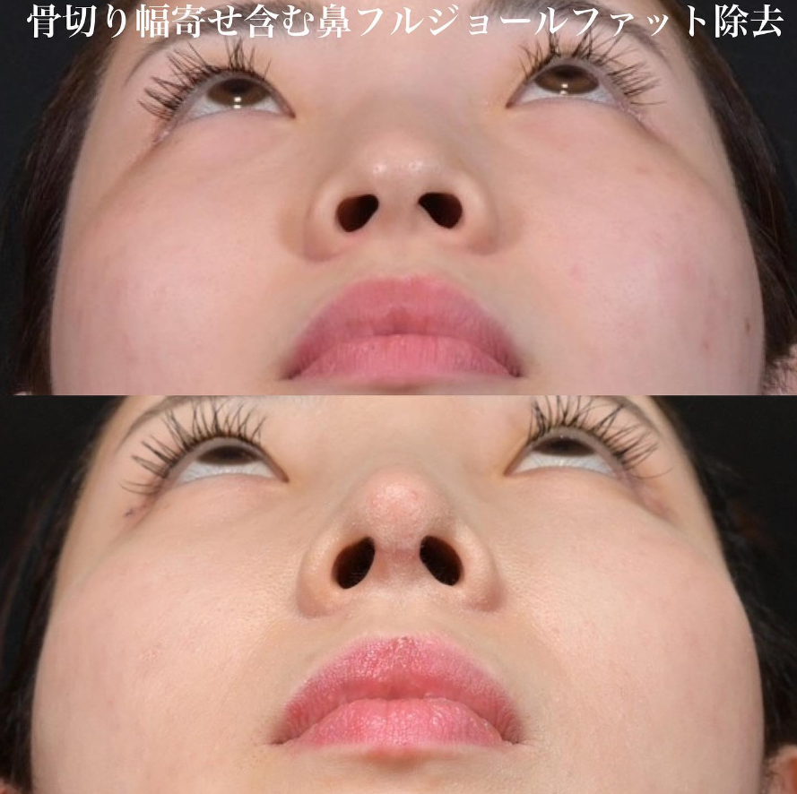 鉄医師による鼻整形の施術前／施術後1ヶ月