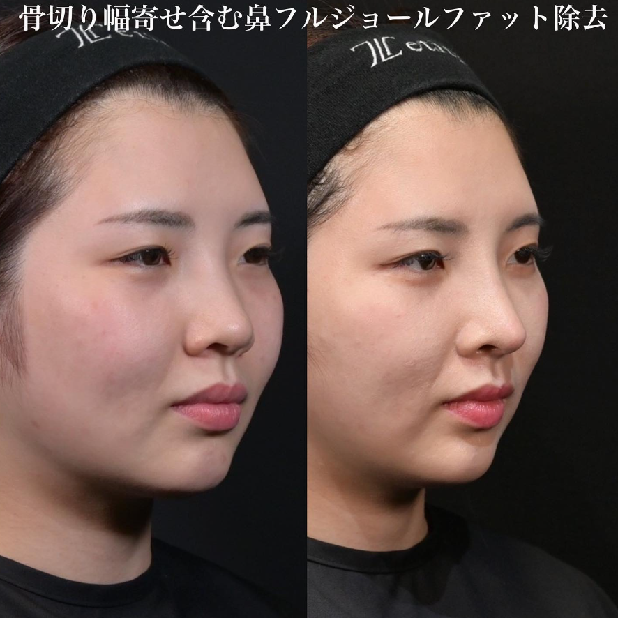 鉄医師による鼻整形の施術前／施術後1ヶ月 Sau 