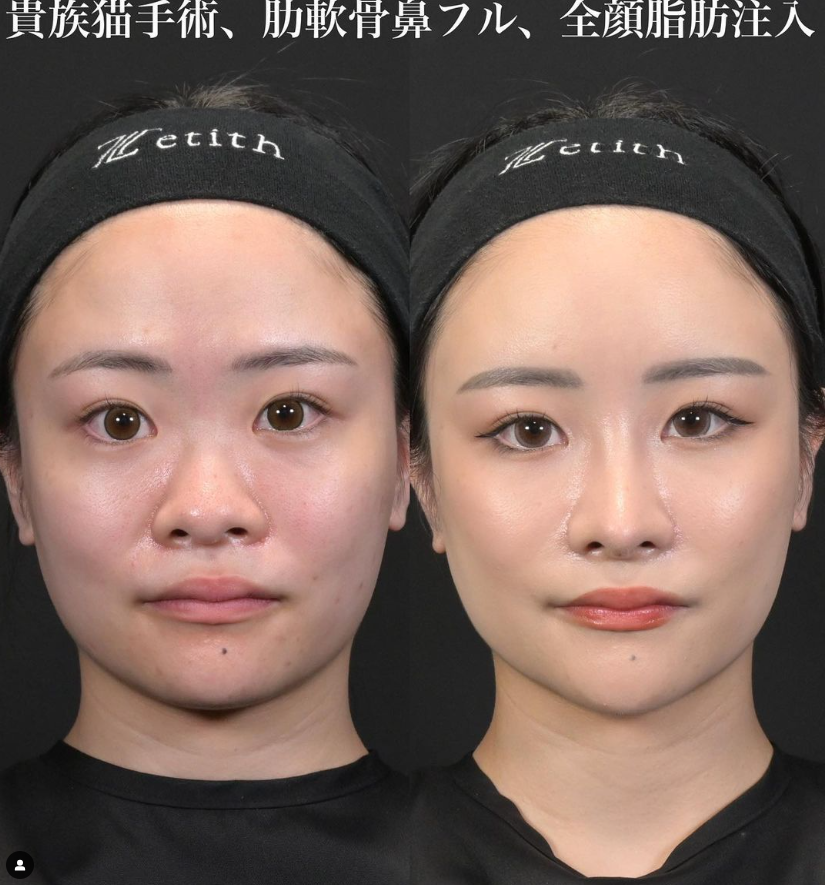 鉄医師による鼻整形の施術前／施術後1ヶ月 หลัง 