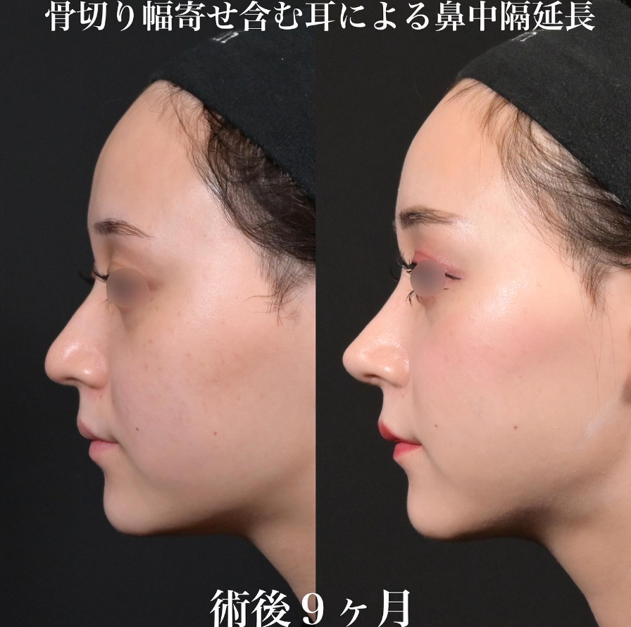 鉄医師による鼻整形の施術前／施術後9ヶ月