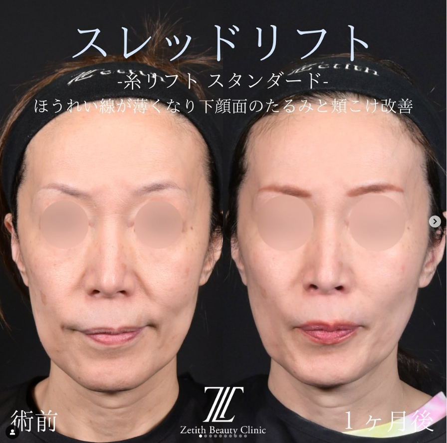 林医師による糸リフトの施術前／施術後1ヵ月
