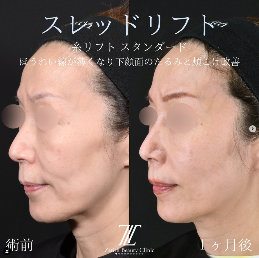 林医師による糸リフトの施術前／施術後1ヵ月 施術後 