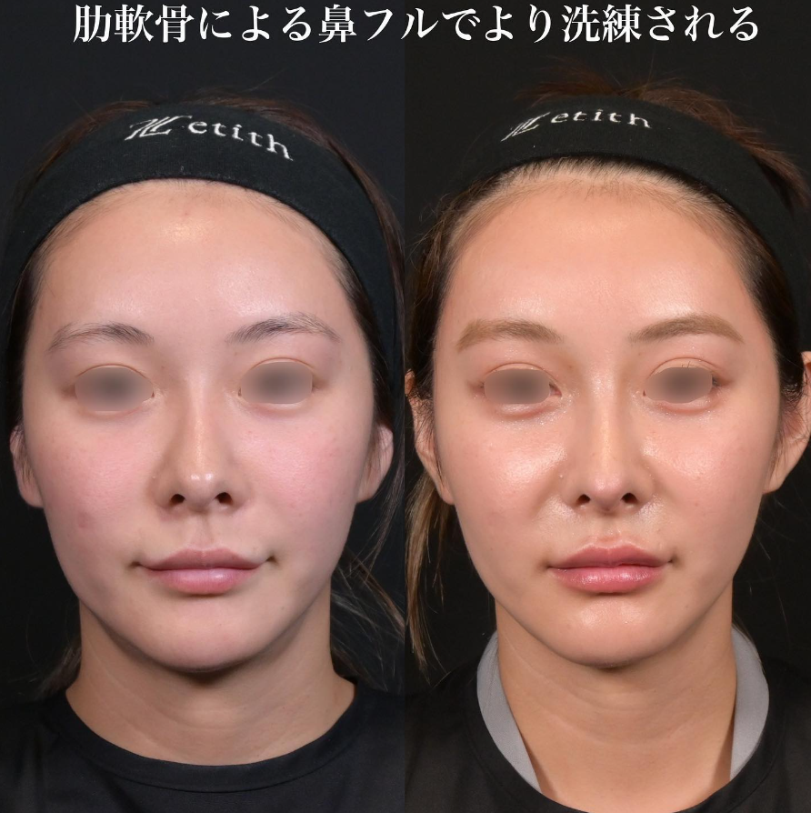 鉄医師による鼻整形の施術前／施術後1ヶ月
