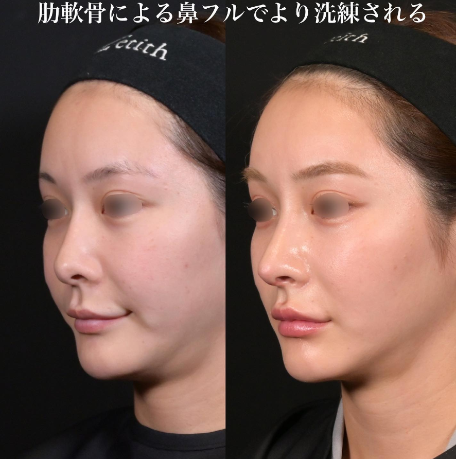 鉄医師による鼻整形の施術前／施術後1ヶ月 术后 