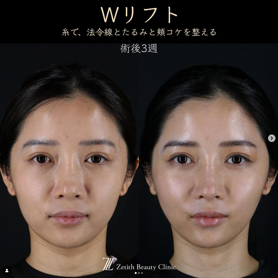 王医師による糸リフトの施術前／施術後3週間