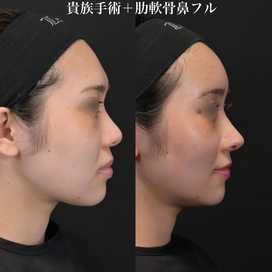 鉄医師による鼻整形の施術前／施術後1ヶ月
