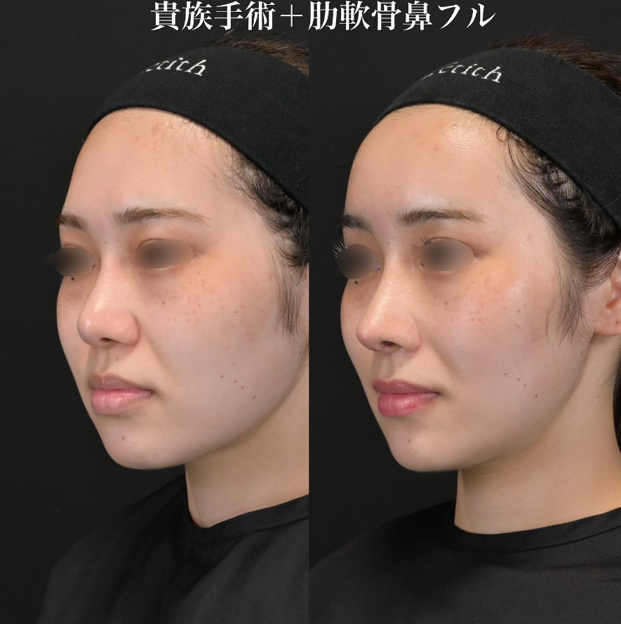 鉄医師による鼻整形の施術前／施術後1ヶ月 施術後 