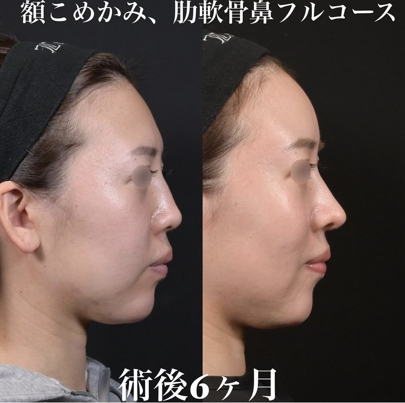 鉄医師による鼻整形の施術前／施術後6ヶ月