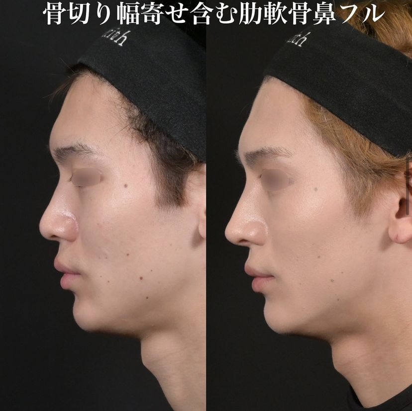 鉄医師による鼻整形の施術前／施術後6ヶ月