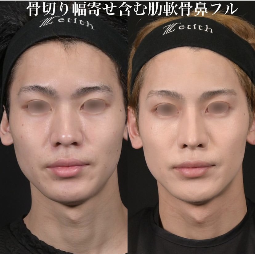 鉄医師による鼻整形の施術前／施術後6ヶ月 术后 