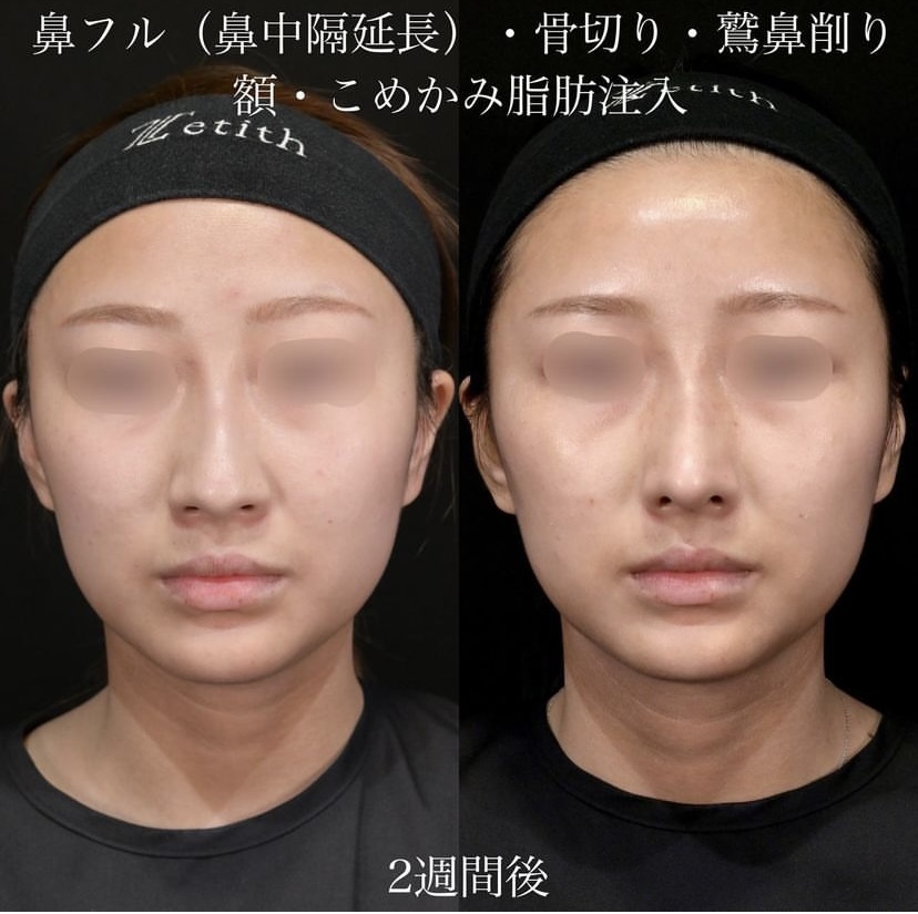 上木原医師による鼻整形の施術前／施術後2週間