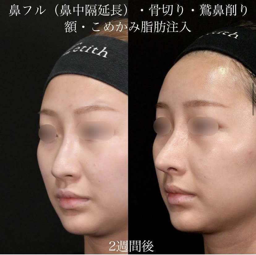 上木原医師による鼻整形の施術前／施術後2週間 施術後 