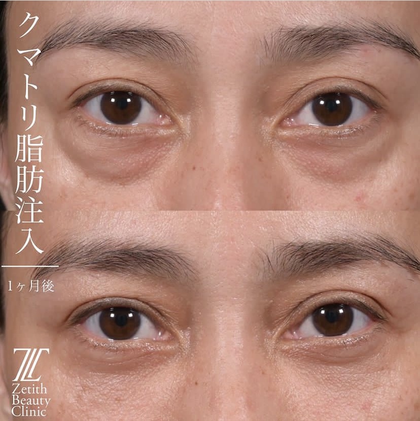 上木原医師によるクマ治療の施術前／施術後1ヶ月