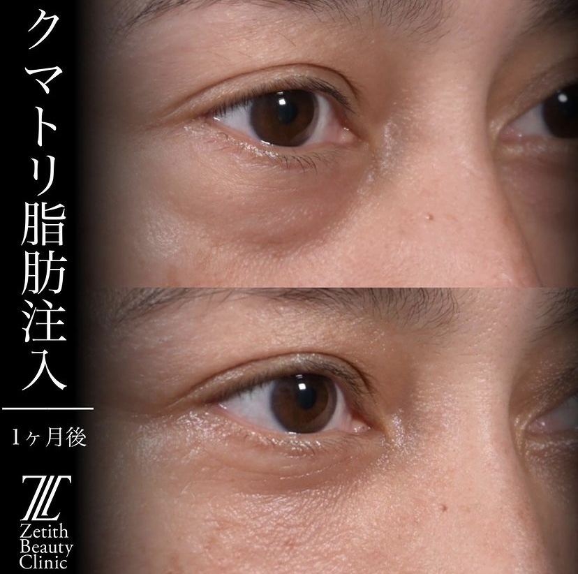 上木原医師によるクマ治療の施術前／施術後1ヶ月 Sonra 