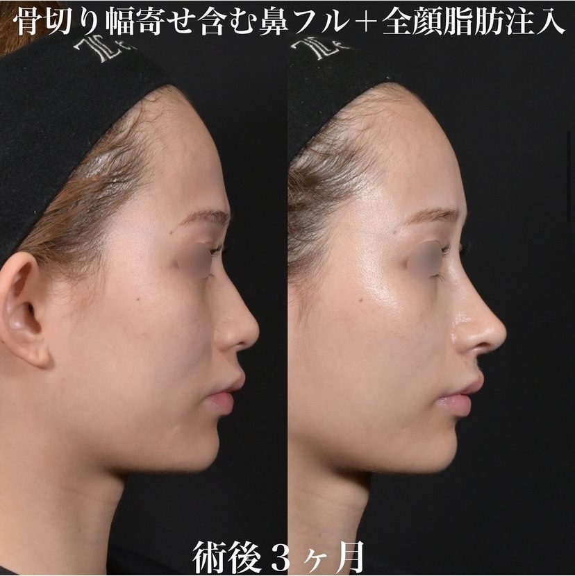 鉄医師による鼻整形の施術前／施術後3ヶ月