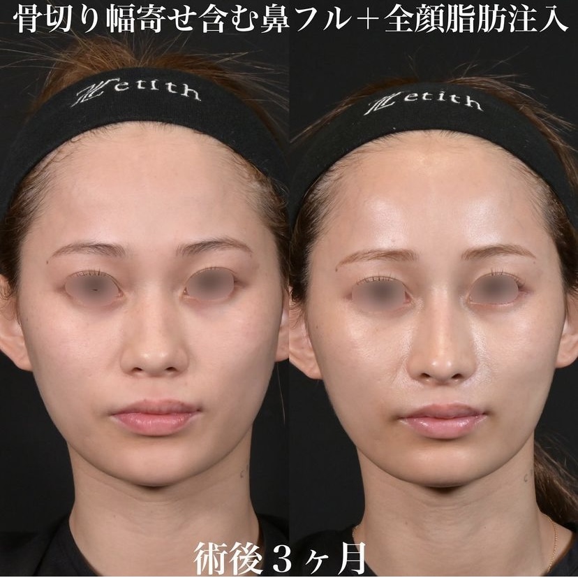 鉄医師による鼻整形の施術前／施術後3ヶ月 Дараа 