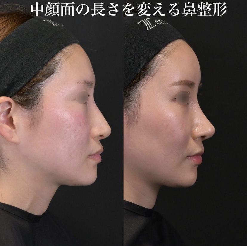 鉄医師による鼻整形の施術後1ヶ月
