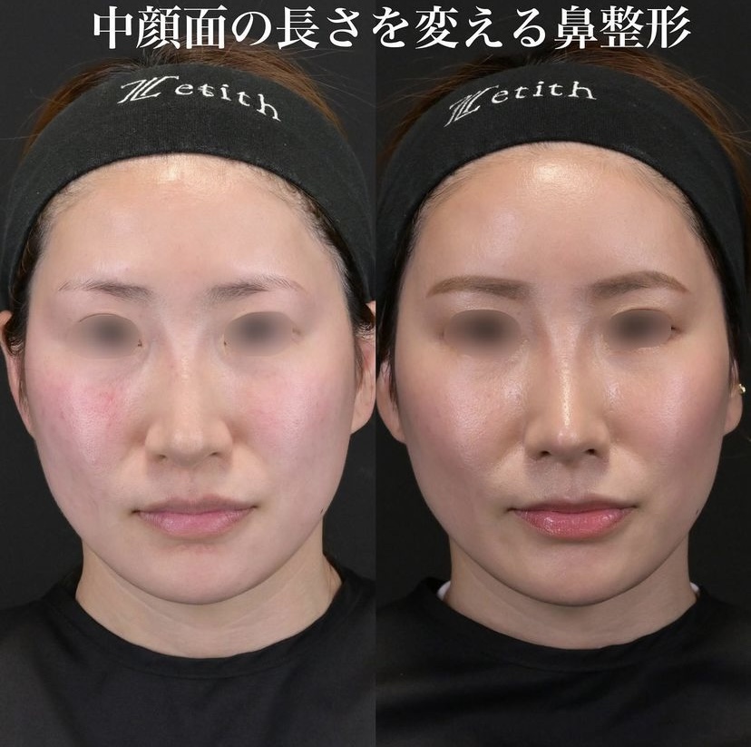 鉄医師による鼻整形の施術後1ヶ月 施術後 