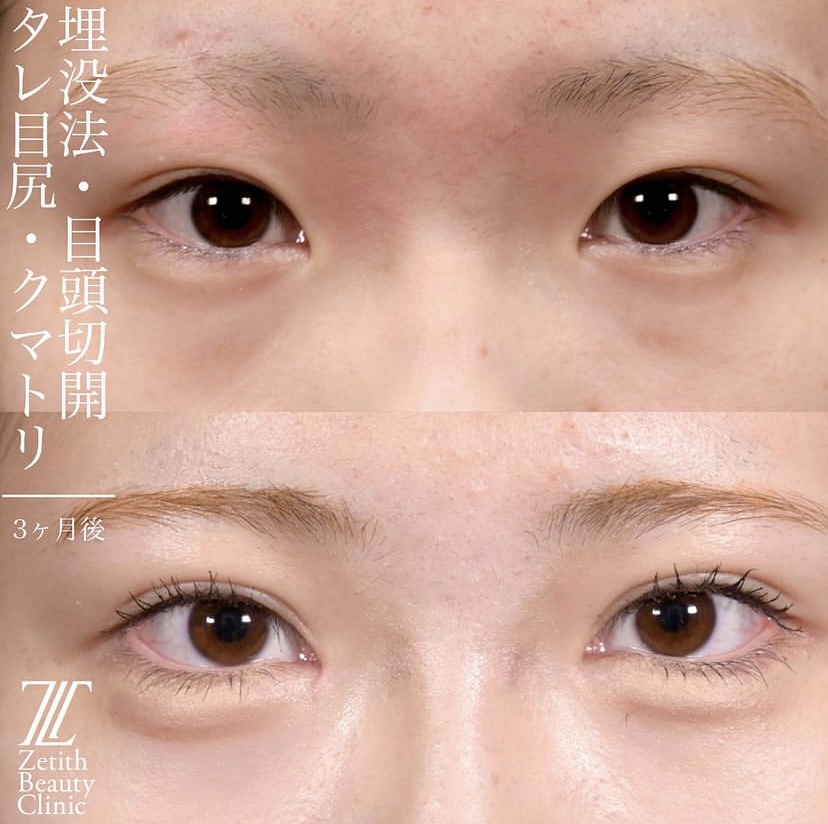 上木原医師による目元整形の施術前／施術後3ヶ月