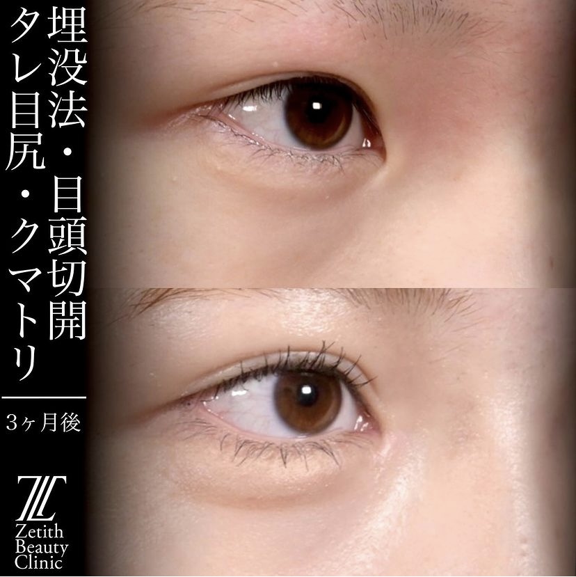 上木原医師による目元整形の施術前／施術後3ヶ月 After 