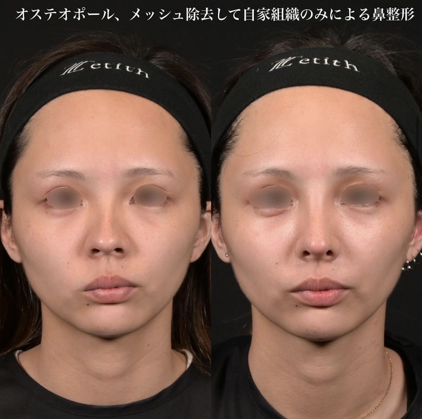 鉄医師による鼻整形の施術前／施術後2週間