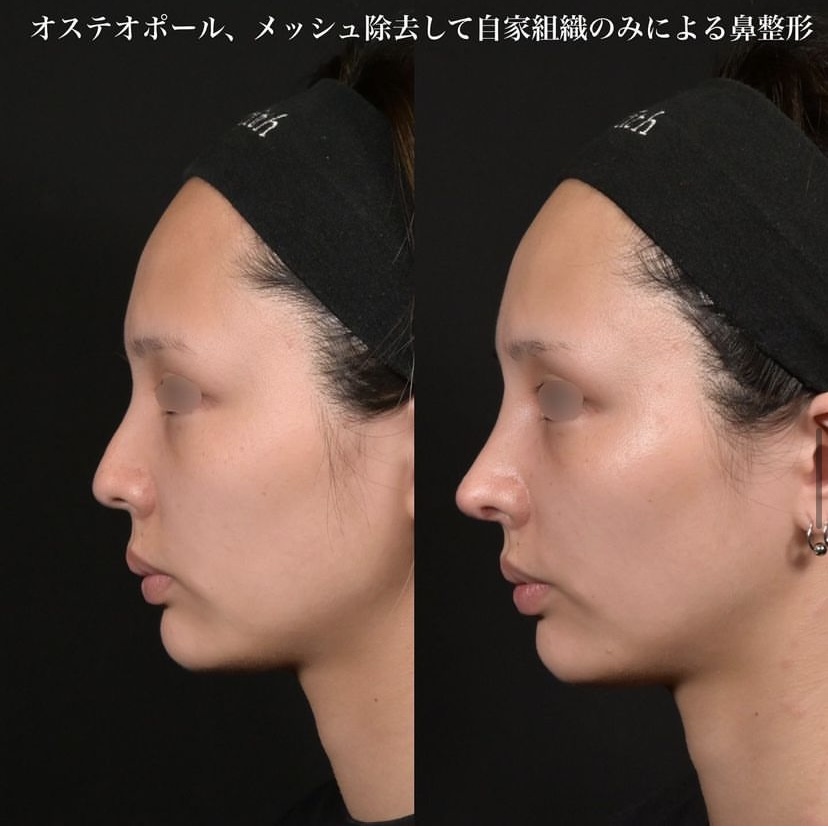 鉄医師による鼻整形の施術前／施術後2週間 Sau 