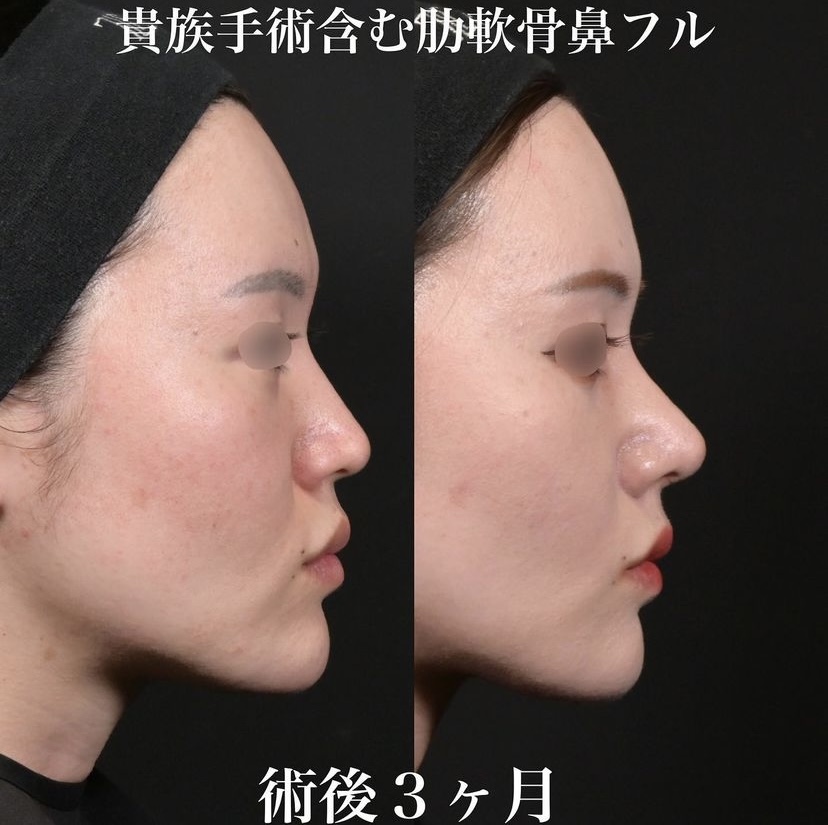 鉄医師による鼻整形の施術前／施術後3ヶ月
