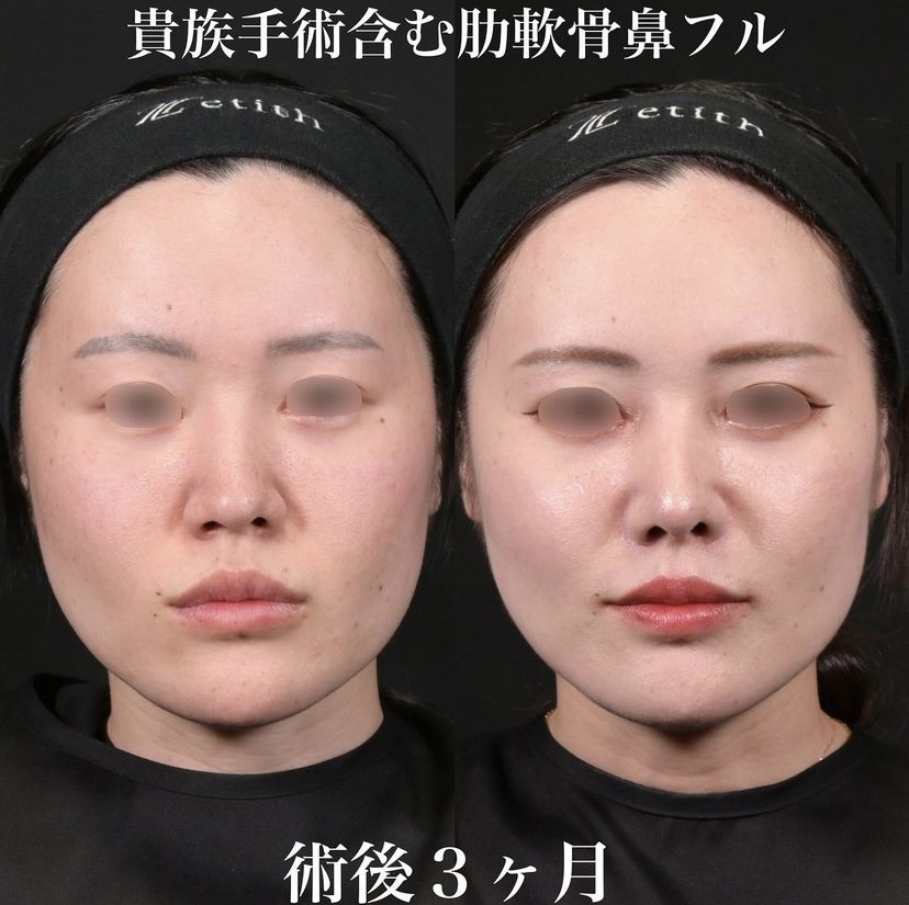 鉄医師による鼻整形の施術前／施術後3ヶ月 术后 