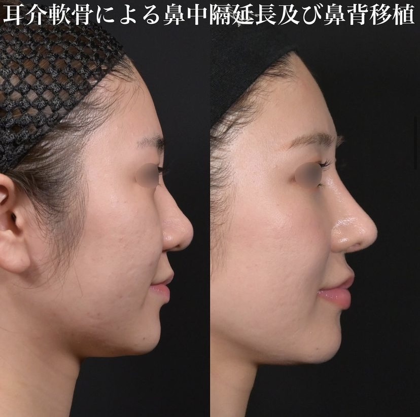 鉄医師による鼻整形の施術前／施術後1年6ヶ月