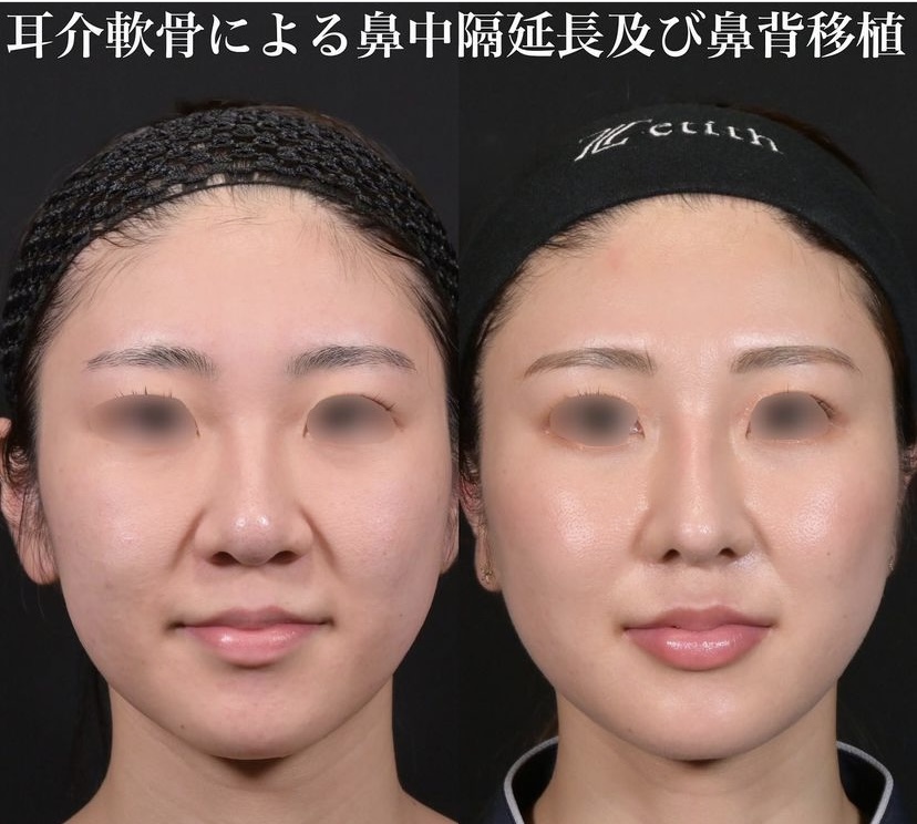 鉄医師による鼻整形の施術前／施術後1年6ヶ月 施術後 