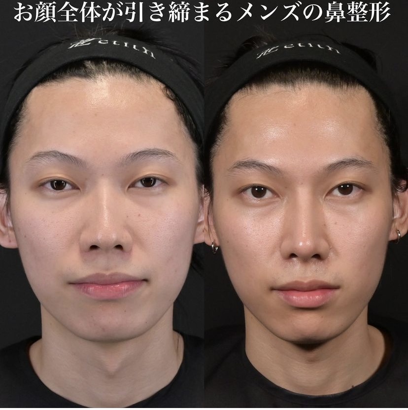 鉄医師による鼻整形の施術前／施術後1ヶ月