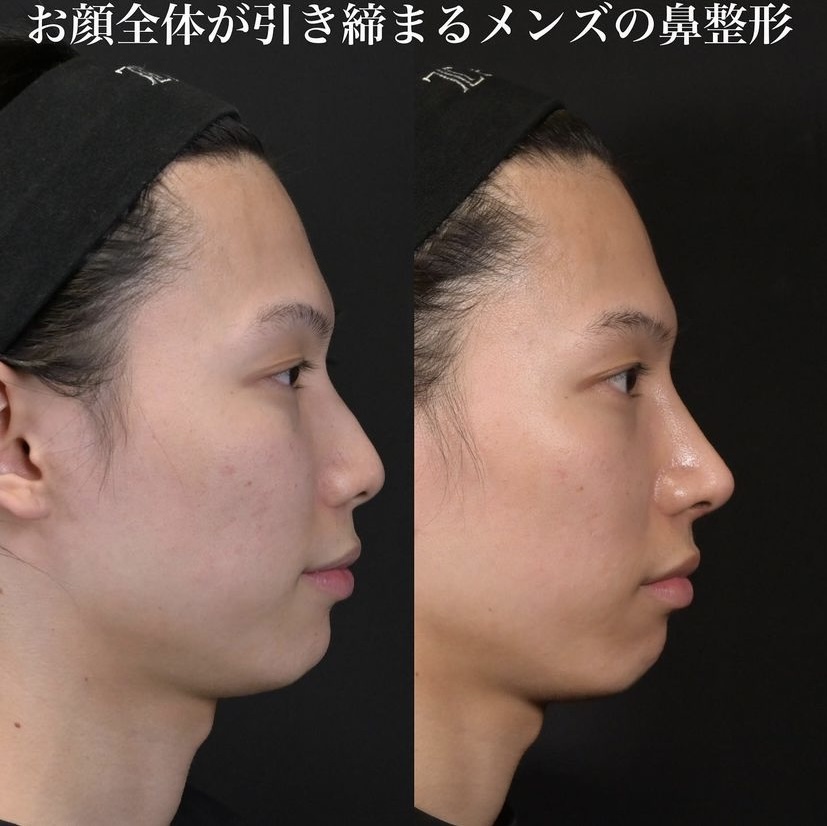 鉄医師による鼻整形の施術前／施術後1ヶ月 术后 