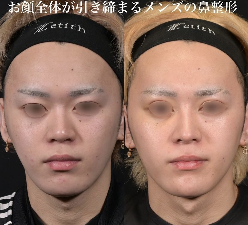 鉄医師による鼻整形の施術前／施術後5ヶ月