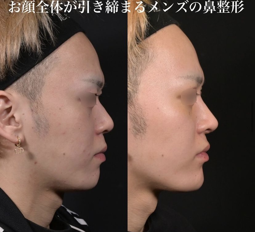 鉄医師による鼻整形の施術前／施術後5ヶ月 Дараа 